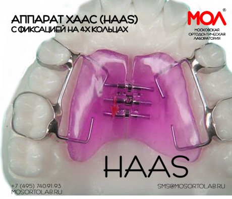 Аппарат Хаас (Haas) с фиксацией на 4-х кольцах