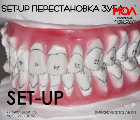Перестановка (set-up) одного зуба