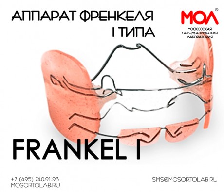 Регулятор функций Френкеля (Frankel) I типа (Frankel I) при протрузии резцов на верхней челюсти, дистальная окклюзия