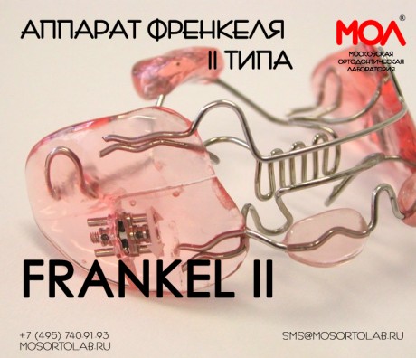 Регулятор функций Френкеля (Frankel) II типа (Frankel II) при ретрузии резцов на верхней челюсти, дистальная окклюзия