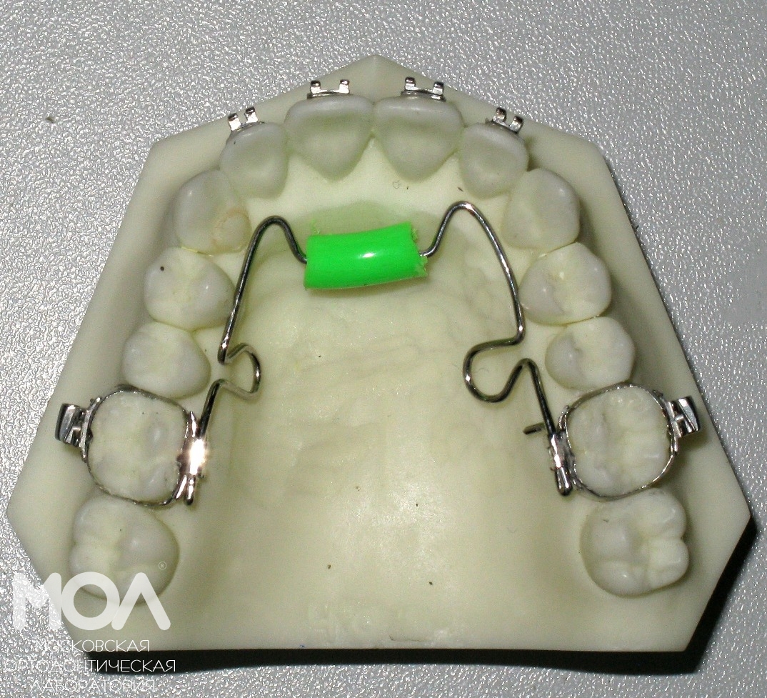 Аппарат хасса. Тугарина несъемный аппарат ортодонтический. Пластинка Шварца ортодонтия.